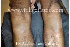 Vitiligo Treatment in India