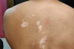 Vitiligo Treatment in India